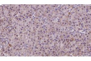 ABIN6273219 at 1/100 staining Human pancreas cancer tissue by IHC-P. (CTNNA3 antibody  (Internal Region))