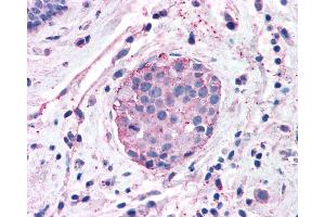 Anti-XPR1 antibody IHC of human Breast, Carcinoma.