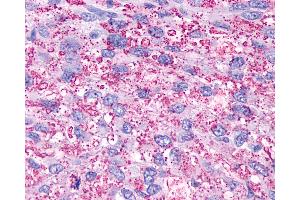 Anti-P2Y13 / P2RY13 antibody IHC of human Brain, Glioblastoma. (Purinergic Receptor P2Y, G-Protein Coupled, 13 (P2RY13) (Extracellular Domain) antibody)