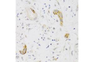 Immunohistochemistry of paraffin-embedded human liver cancer using PCM1 Antibody (ABIN1876897) at dilution of 1:100 (40x lens). (PCM1 antibody)