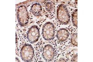 Immunohistochemical analysis of TSSK6 staining in human colon cancer formalin fixed paraffin embedded tissue section. (TSSK6 antibody)