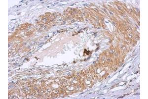 IHC-P Image Immunohistochemical analysis of paraffin-embedded human gastric cancer, using Dystrobrevin beta, antibody at 1:500 dilution. (Dystrobrevin beta antibody)