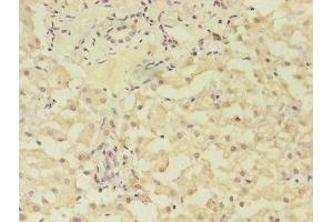 Immunohistochemistry of paraffin-embedded human liver cancer using ABIN7153293 at dilution of 1:100