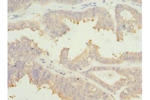 Immunohistochemistry of paraffin-embedded human prostate cancer using ABIN7172902 at dilution of 1:100 (EIF2B1 antibody  (AA 1-305))