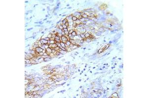Immunohistochemical analysis of paraffin- embedded human lung adenocarcinoma tissue using FGFR1 (Ab-154) Antibody (E022077). (FGFR1 antibody)
