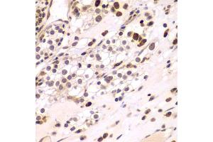 Immunohistochemistry of paraffin-embedded human kidney cancer using CEBPG antibody (ABIN5974381) at dilution of 1/100 (40x lens). (CEBPG antibody)