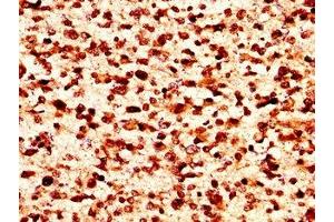 IHC image of nforHU diluted at 1:50 and staining in paraffin-embedded human glioma performed on a Leica BondTM system. (HIST1H1C antibody)