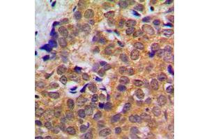 Immunohistochemical analysis of STAT5 staining in human breast cancer formalin fixed paraffin embedded tissue section. (STAT5A antibody  (C-Term))