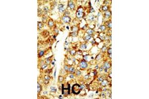 Formalin-fixed and paraffin-embedded human hepatocellular carcinoma tissue reacted with the SETD8 polyclonal antibody  , which was peroxidase-conjugated to the secondary antibody, followed by DAB staining. (SETD8 antibody  (AA 25-53))