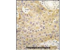Formalin-fixed and paraffin-embedded human hepatocarcinoma tissue reacted with GRK5 Antibody (C-term) (ABIN390988 and ABIN2841171) , which was peroxidase-conjugated to the secondary antibody, followed by DAB staining. (GRK5 antibody  (C-Term))