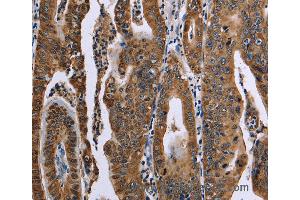 Immunohistochemistry of Human gastric cancer using FAF1 Polyclonal Antibody at dilution of 1:50 (FAF1 antibody)