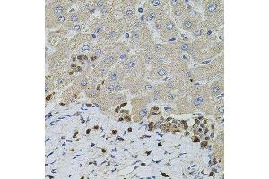 Immunohistochemistry of paraffin-embedded human liver injury using S100A12 antibody. (S100A12 antibody  (AA 1-92))
