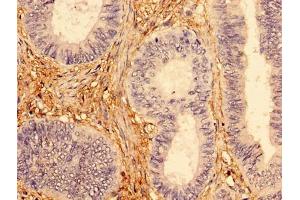 Immunohistochemistry of paraffin-embedded human colon cancer using ABIN7173954 at dilution of 1:100 (INPP5A antibody  (AA 1-409))