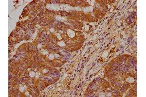 IHC image of ABIN7164121 diluted at 1:400 and staining in paraffin-embedded human colon cancer performed on a Leica BondTM system. (PRAMEF18 antibody  (AA 1-257))