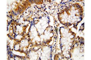 Anti-Caspase-10 antibody, IHC(P) IHC(P): Human Intestinal Cancer Tissue (Caspase 10 antibody  (N-Term))