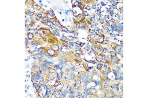 Immunohistochemistry of paraffin-embedded Human lung cancer using KIF17 Rabbit pAb (ABIN7268123) at dilution of 1:100 (40x lens).