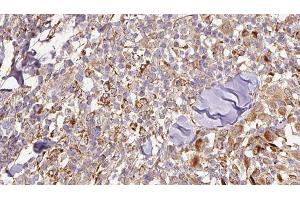 ABIN6276844 at 1/100 staining Human Melanoma tissue by IHC-P. (SCGB1A1 antibody  (Internal Region))