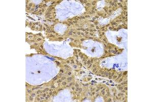 Immunohistochemistry of paraffin-embedded human oophoroma using XPO5 antibody at dilution of 1:100 (x400 lens).