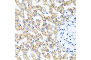 Immunohistochemistry of paraffin-embedded human liver injury using RIPK4 antibody. (RIPK4 antibody  (AA 240-520))