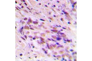 Immunohistochemical analysis of CDYL2 staining in human breast cancer formalin fixed paraffin embedded tissue section. (CDYL2 antibody  (N-Term))