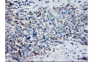 Immunohistochemical staining of paraffin-embedded Adenocarcinoma of Human colon tissue using anti-XPNPEP3 mouse monoclonal antibody. (XPNPEP3 antibody)
