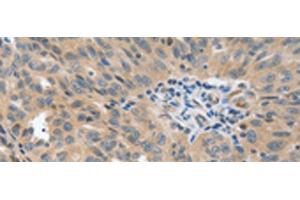 Immunohistochemistry of paraffin-embedded Human ovarian cancer tissue using P2RY6 Polyclonal Antibody at dilution of 1:40(x200) (P2RY6 antibody)
