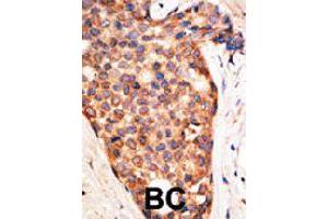Formalin-fixed and paraffin-embedded human cancer tissue reacted with XIAP polyclonal antibody  , which was peroxidase-conjugated to the secondary antibody, followed by AEC staining. (XIAP antibody  (N-Term))