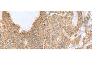 Immunohistochemistry of paraffin-embedded Human thyroid cancer tissue using CSRP2 Polyclonal Antibody at dilution of 1:60(x200) (CSRP2 antibody)
