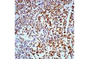 Immunohistochemical analysis of Gamma-enolase staining in human lung cancer formalin fixed paraffin embedded tissue section. (ENO2/NSE antibody)