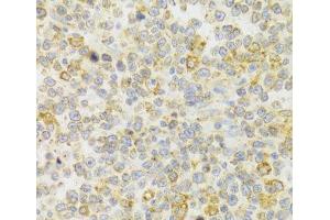 Immunohistochemistry of paraffin-embedded Human B cell lymphoma using KISS1R Polyclonal Antibody at dilution of 1:100 (40x lens). (KISS1R antibody)
