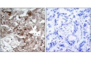 Immunohistochemistry analysis of paraffin-embedded human breast carcinoma tissue, using Cortactin (Ab-466) Antibody. (Cortactin antibody  (AA 441-490))