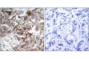 Immunohistochemistry analysis of paraffin-embedded human breast carcinoma tissue, using Cortactin (Ab-466) Antibody.