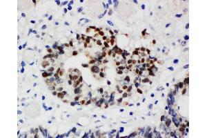 Anti-Nucleophosmin antibody, IHC(P) IHC(P): Human Intestinal Cancer Tissue (NPM1 antibody  (N-Term))