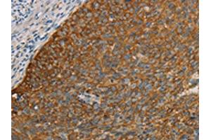 The image on the left is immunohistochemistry of paraffin-embedded Human cervical cancer tissue using ABIN7190690(FOXF2 Antibody) at dilution 1/30, on the right is treated with synthetic peptide. (FOXF2 antibody)
