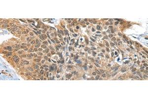Immunohistochemistry of paraffin-embedded Human esophagus cancer tissue using BOLA1 Polyclonal Antibody at dilution of 1:35(x200) (BOLA1 antibody)