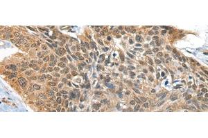 Immunohistochemistry of paraffin-embedded Human esophagus cancer tissue using BOLA1 Polyclonal Antibody at dilution of 1:35(x200)