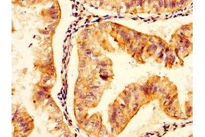 IHC image of ABIN7159714 diluted at 1:300 and staining in paraffin-embedded human endometrial cancer performed on a Leica BondTM system. (MFAP5 antibody  (AA 22-173))