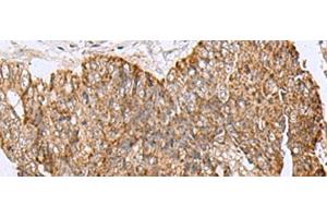 Immunohistochemistry of paraffin-embedded Human colorectal cancer tissue using HCCS Polyclonal Antibody at dilution of 1:110(x200) (HCCS antibody)