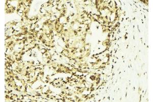 ABIN6273143 at 1/100 staining Human breast cancer tissue by IHC-P.