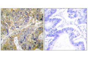 Immunohistochemistry analysis of paraffin-embedded human colon carcinoma tissue, using ES8L3 antibody.