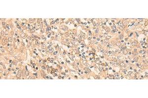 Immunohistochemistry of paraffin-embedded Human cervical cancer tissue using EIF2B5 Polyclonal Antibody at dilution of 1:25(x200)