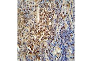 Formalin fixed, paraffin embedded human lung carcinoma stained with PUS3 Antibody (N-term) followed by peroxidase conjugation of the secondary antibody and DAB staining. (PUS3 antibody  (N-Term))