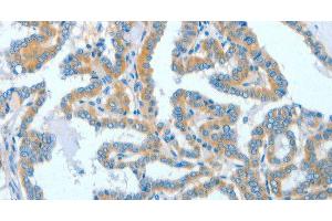 Immunohistochemistry of paraffin-embedded Human thyroid cancer tissue using ASCC1 Polyclonal Antibody at dilution 1:50 (ASCC1 antibody)