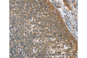 Immunohistochemistry of Human thyroid cancer using TNFRSF10D Polyclonal Antibody at dilution of 1:40 (DcR2 antibody)