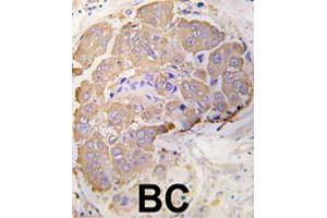 Formalin-fixed and paraffin-embedded human breast carcinoma tissue reacted with HSPB1 polyclonal antibody  , which was peroxidase-conjugated to the secondary antibody, followed by DAB staining.