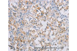 Immunohistochemistry of Human gastric cancer using CERKL Polyclonal Antibody at dilution of 1:50