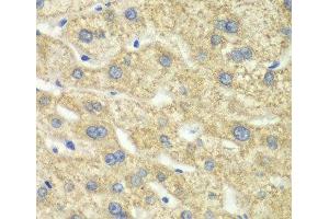 Immunohistochemistry of paraffin-embedded Human liver damage using DLD Polyclonal Antibody at dilution of 1:100 (40x lens). (DLD antibody)