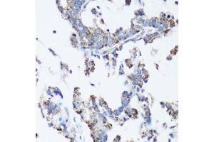 Immunohistochemistry of paraffin-embedded human gastric cancer using Src antibody (ABIN6132240, ABIN6148428, ABIN6148429 and ABIN6215399) at dilution of 1:100 (40x lens).