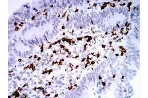 Immunohistochemical analysis of paraffin-embedded rectum cancer tissues using CD2 mouse mAb with DAB staining. (CD2 antibody  (AA 25-140))