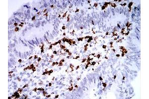 Immunohistochemical analysis of paraffin-embedded rectum cancer tissues using CD2 mouse mAb with DAB staining.